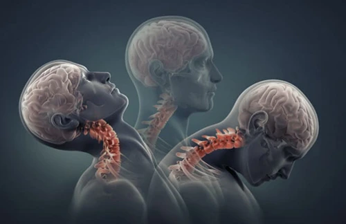 Neck Injuries Caused By Car Wrecks | Pepper & Odom