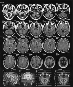 traumatic brain injury